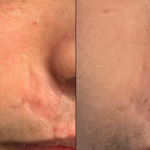 B&A 3 treatments